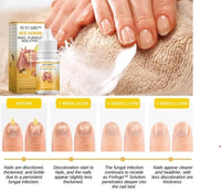 BeeVenom Nail Fungus Solution 15ml Each (Pack of 2) - Faydekasauda