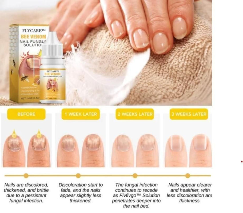 BeeVenom Nail Fungus Solution 15ml Each (Pack of 2) - Faydekasauda